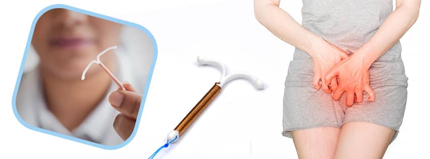 IUD image