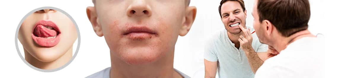 Can-you-get-eczema-on-your-lips