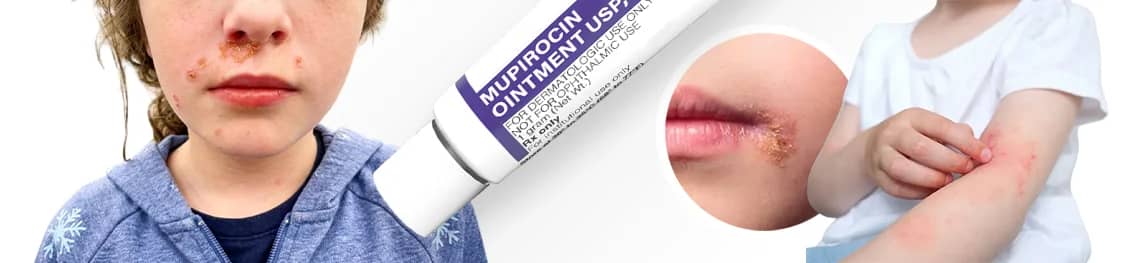 Mupirocin Ointment For Impetigo in a webp image