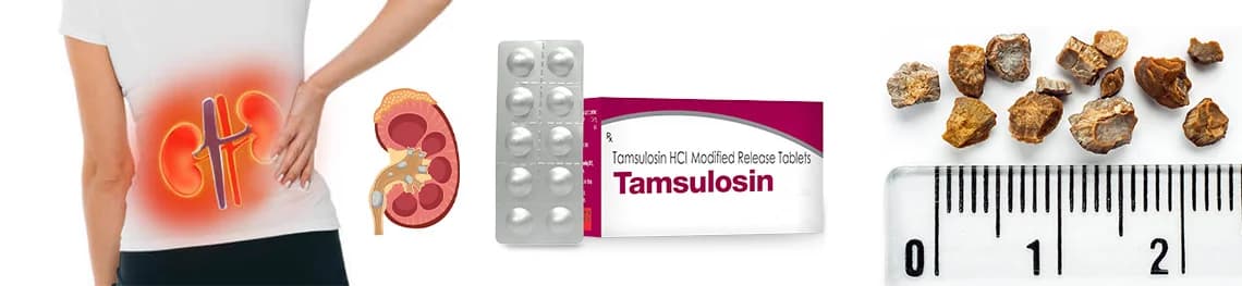 Tamsulosin-for-kidney-stones in a webp image