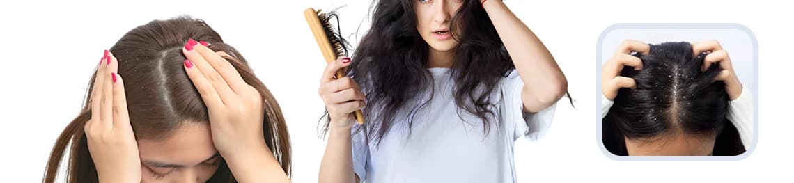 Can-dandruff-cause-hair-loss in a webp image