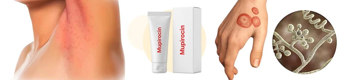 Can You Use Mupirocin Ointment For Yeast Infection in a webp image