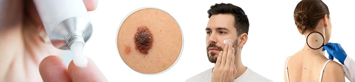 Chemo Cream For Skin Cancer in a webp image