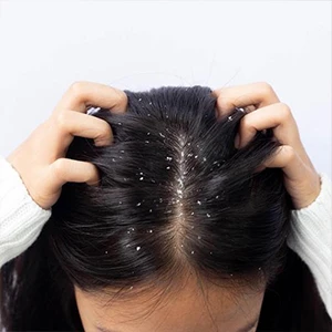 Anti Dandruff
