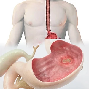 Anti Ulcers