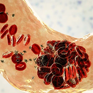 Blood Clots