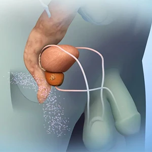 Enlarged Prostate