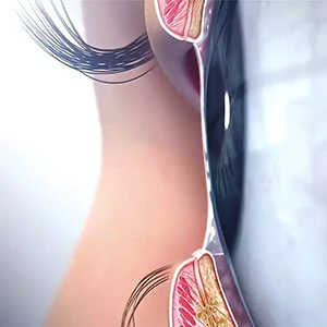 Eye Floaters