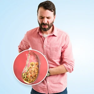Gallstones