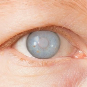 Glaucoma