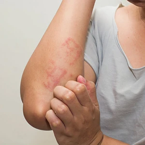 Scabies