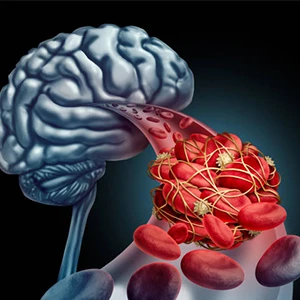 Stroke Due to Blood Clot in Brain