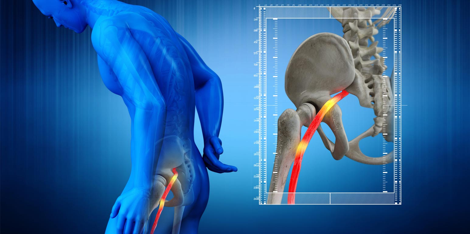 How Gabapentin Can Alleviate Sciatica Symptoms?