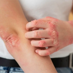 Psoriasis